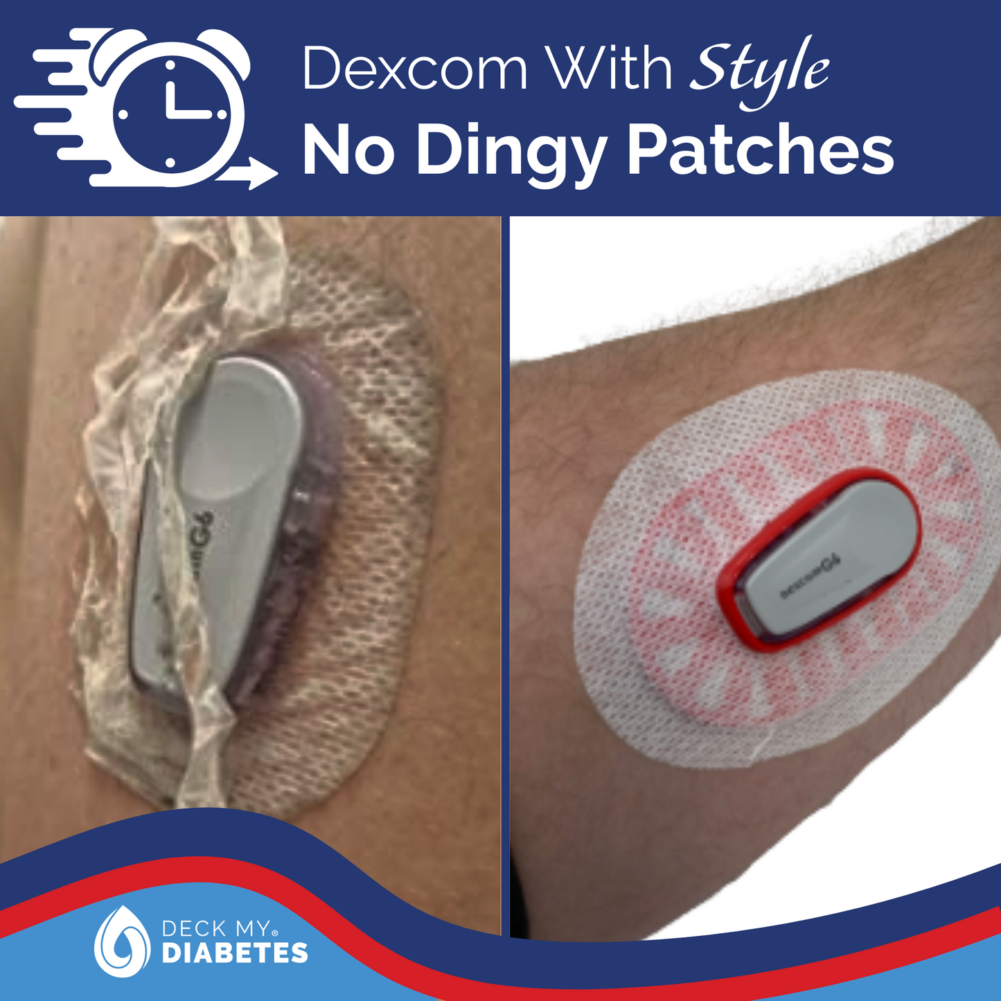 GripShield®  Compatible with Dexcom G6®– 3-Pack Combo | Bump Protectors For Dexcom G6®