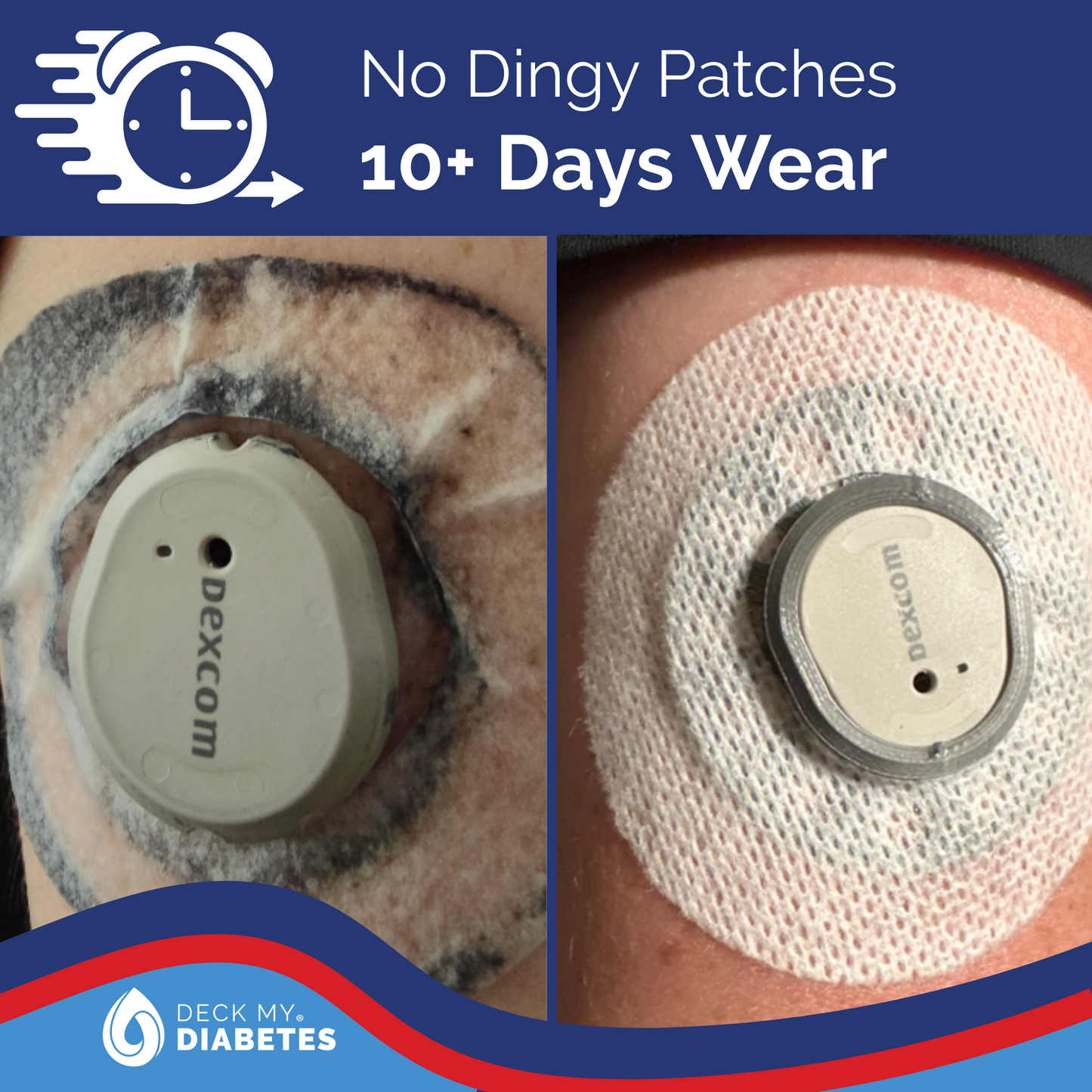 3-Pack Combo- Reusable GripShield®  Compatible with Dexcom G7™/Stelo™| Bump Protector