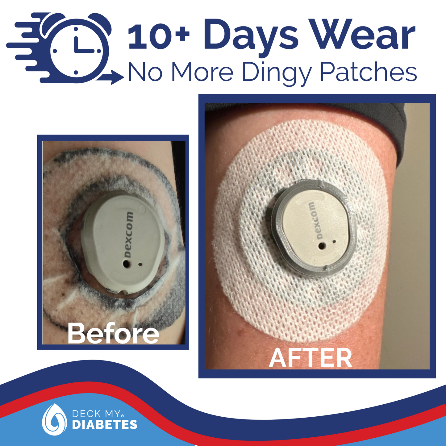 CHAOS Multi-Color Reusable GripShield® Compatible with Dexcom G7™/Stelo™ | Bump Protector | Reusable CGM Bump Protection