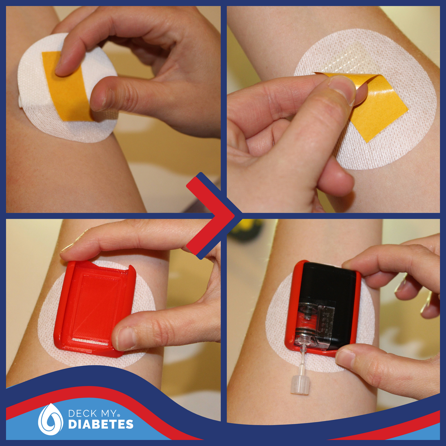 CHAOS-Reusable On Body SugarShield™ Compatible with Tandem Mobi™