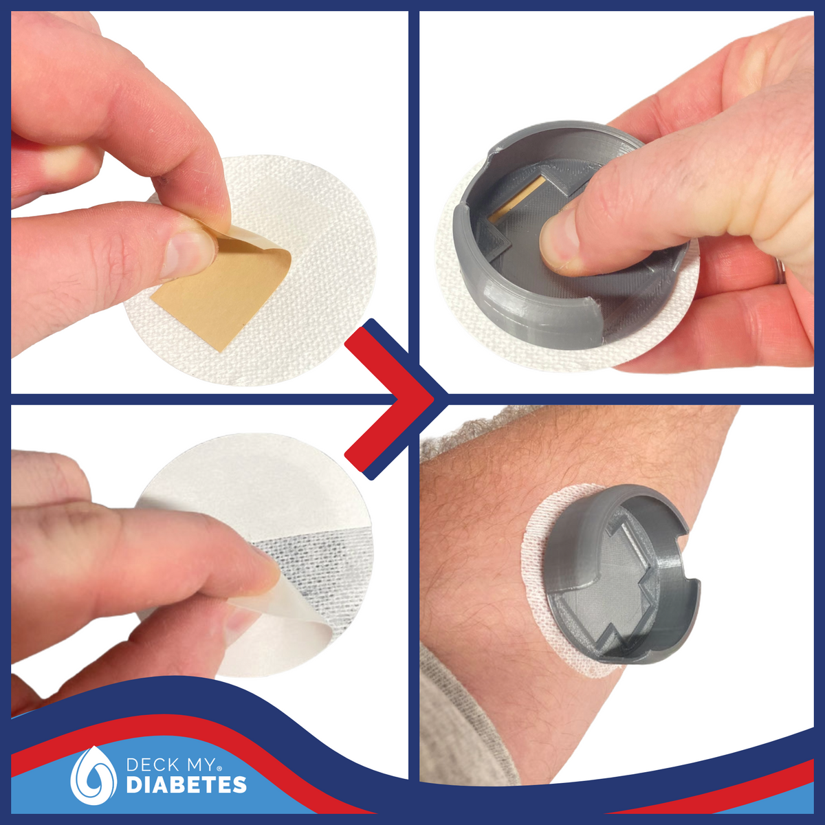 Miss A's Surprise-Reusable On Body SugarShield™ or Horizontal Clip Case Compatible with Twiist™